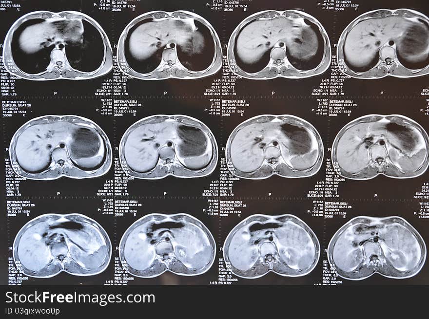 Abdominal MRI image of human body