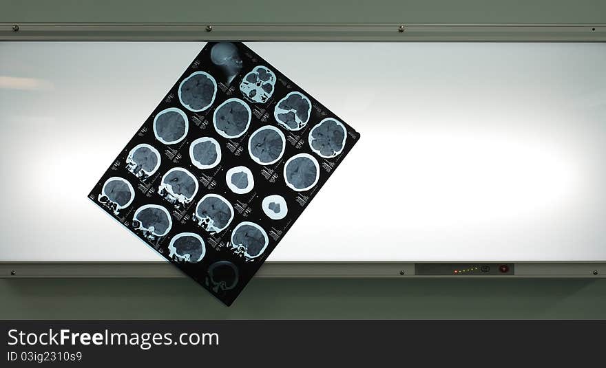 Photo tomogram of the brain, hanging on negatoscope. Photo tomogram of the brain, hanging on negatoscope