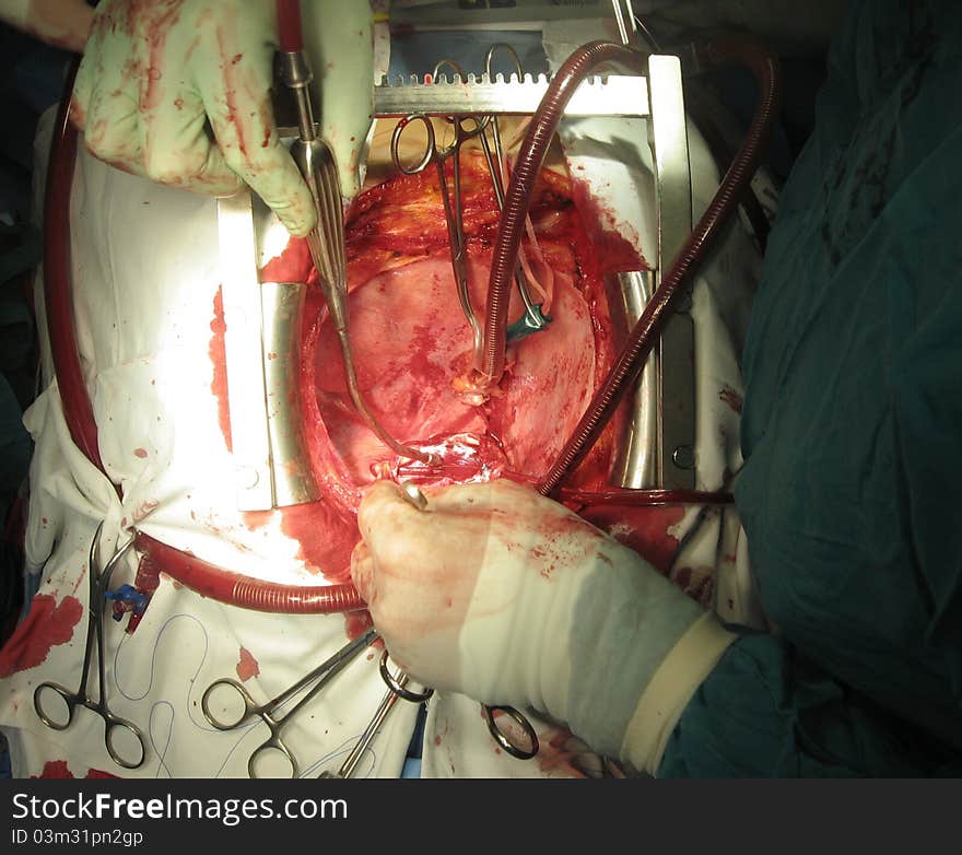 Cardiac transplantation