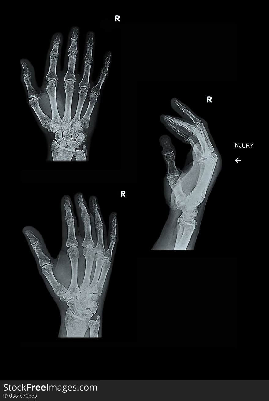 X-Ray set of a right hand with soft tissue showing, 3 views. X-Ray set of a right hand with soft tissue showing, 3 views