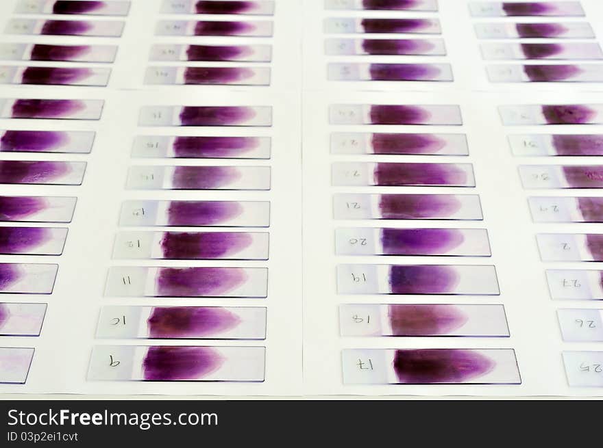 A Blood film waiting for analysis by microscope