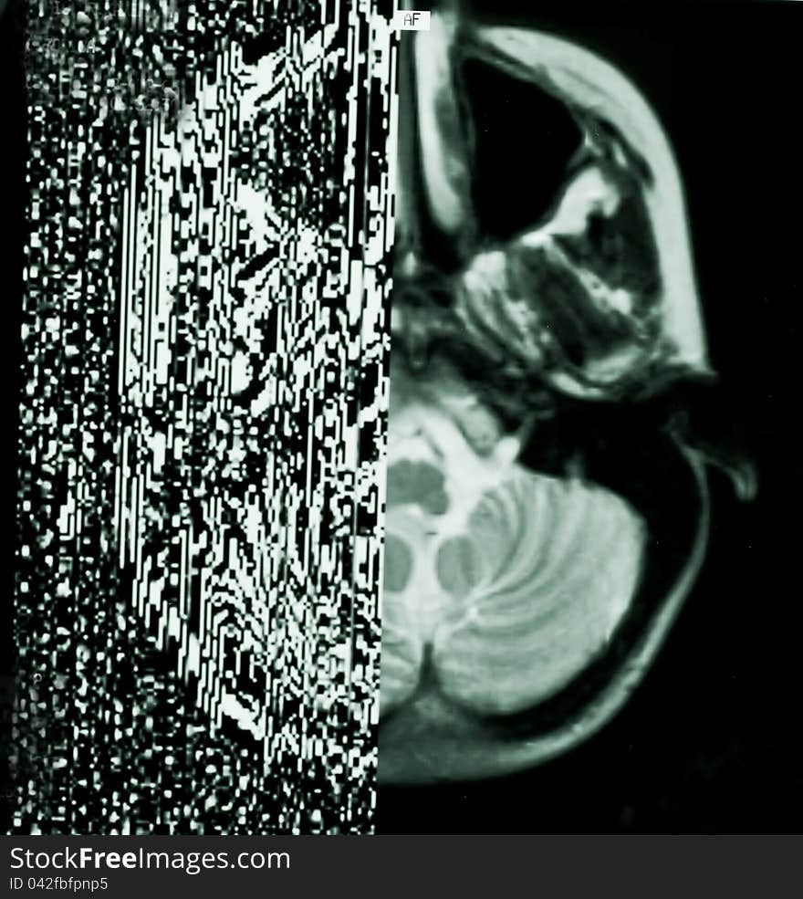 Photo of the transparent laser film with the half of the brain image under heavy error. Photo of the transparent laser film with the half of the brain image under heavy error