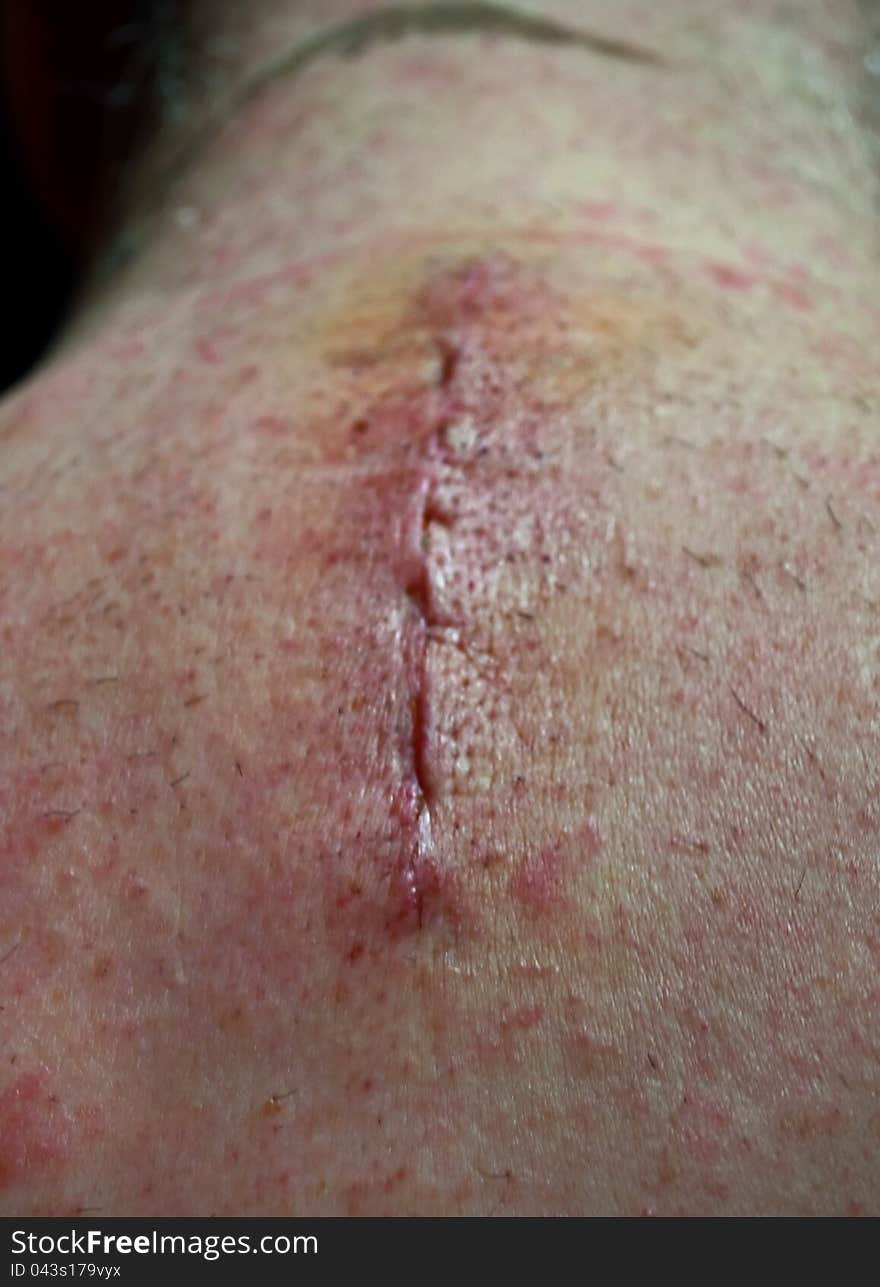 Post Surgery Scar on Back of Neck