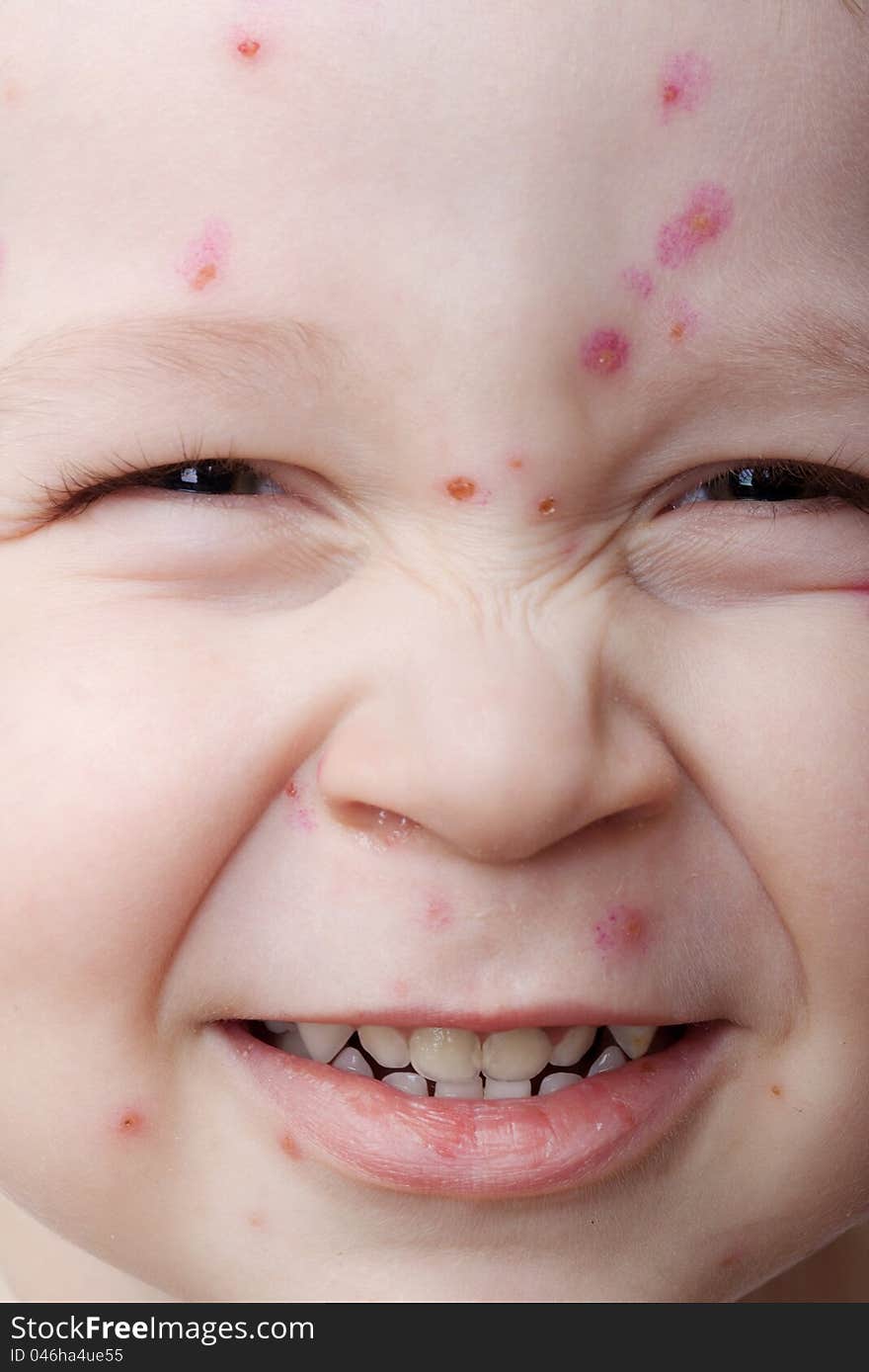 Portrait of a smiling child ailing chickenpox