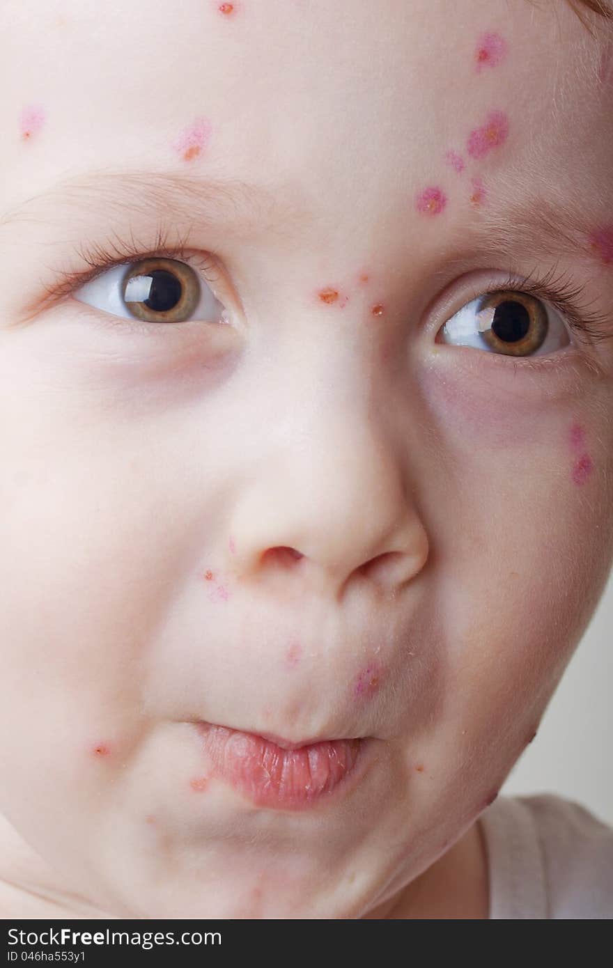 Emotional ill child, close up boy with chickenpox