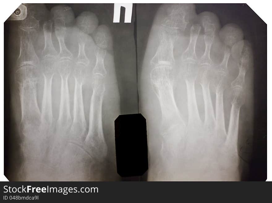 X-ray of the foot. There is no second phalanx of the finger nail.