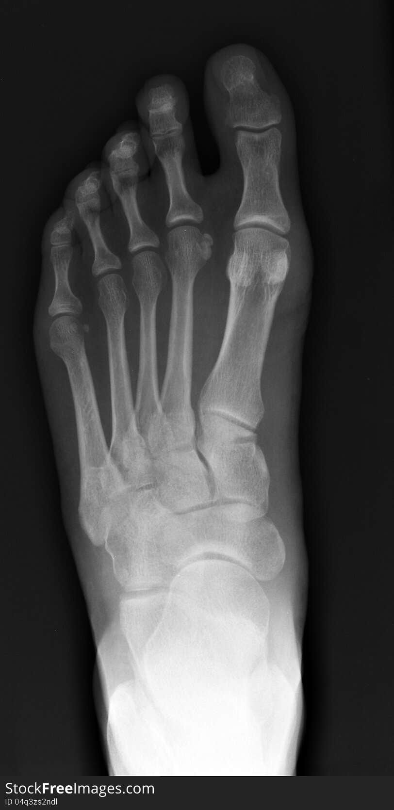 X-ray, top view of a left foot