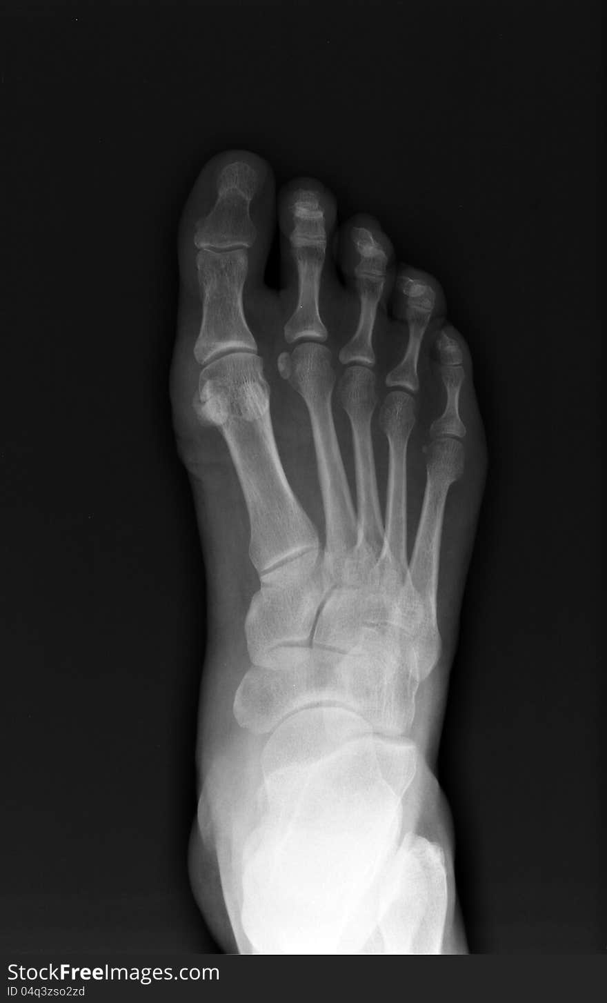 X-Ray