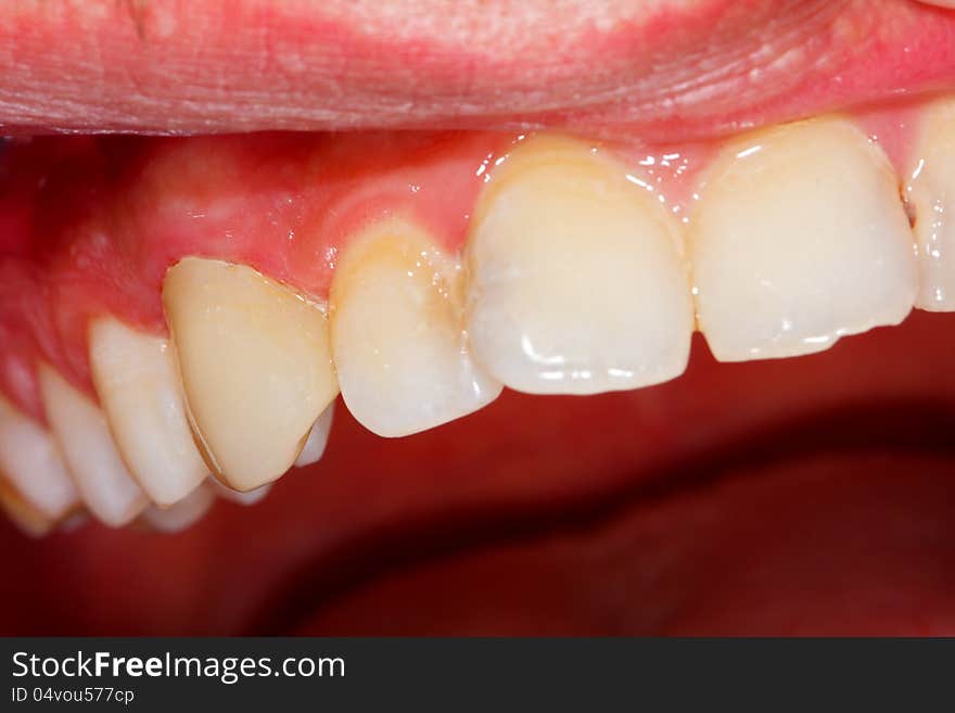 Ceramic crown on tooth