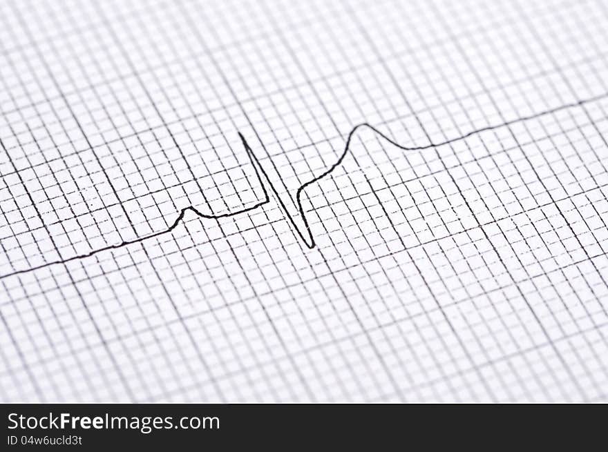 Closeup of twelve lead electrocardiogram graph showing ventrical activation time and amplitude