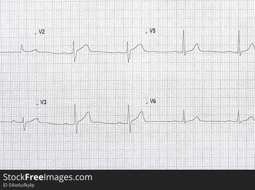 Twelve lead electrocardiogram graph with abnormal first degree AV block