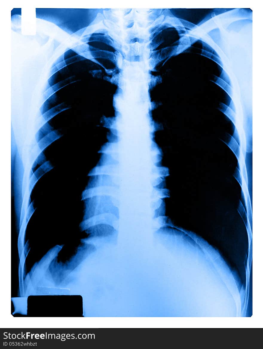 X-Ray Image Of Human Chest, Blue