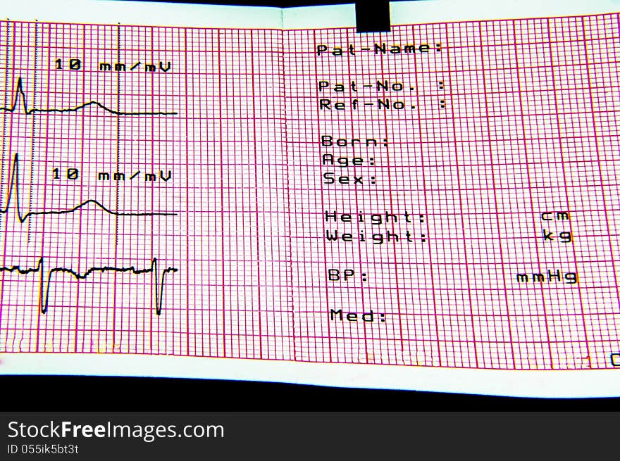 ECG and EKG are conducted on patients. The heart monitoring device produces the sheet. ECG and EKG are conducted on patients. The heart monitoring device produces the sheet.