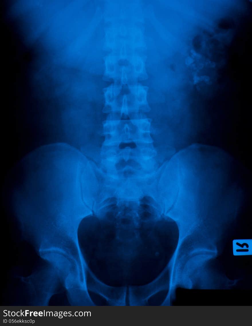 X-ray film of stone in the bladder.