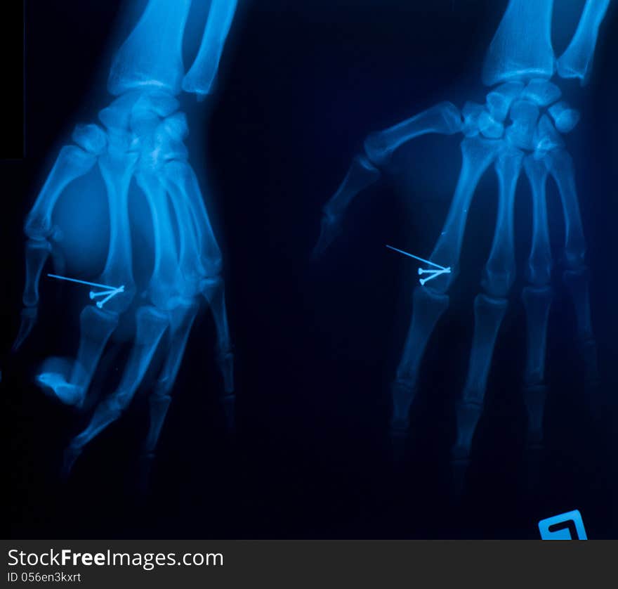 X – ray film of the hand and nails