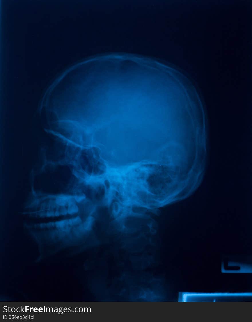 X ray film of skull lateral