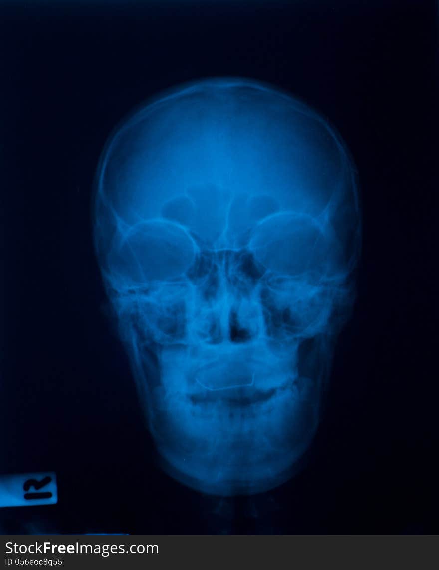 X ray film of front skull