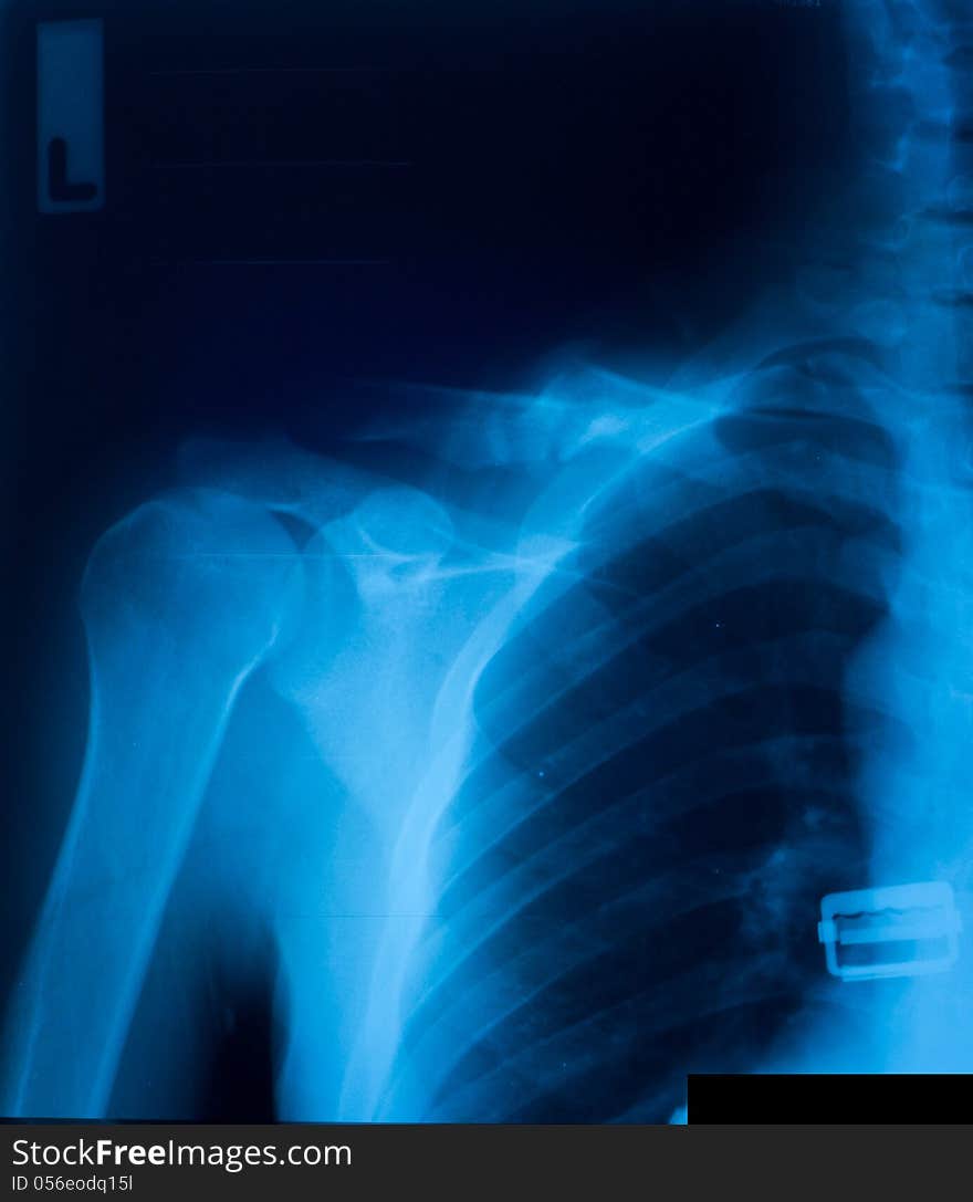 X-ray film of clavicle fracture.