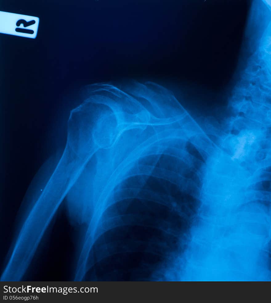 X ray film of clavicle fracture. X ray film of clavicle fracture.