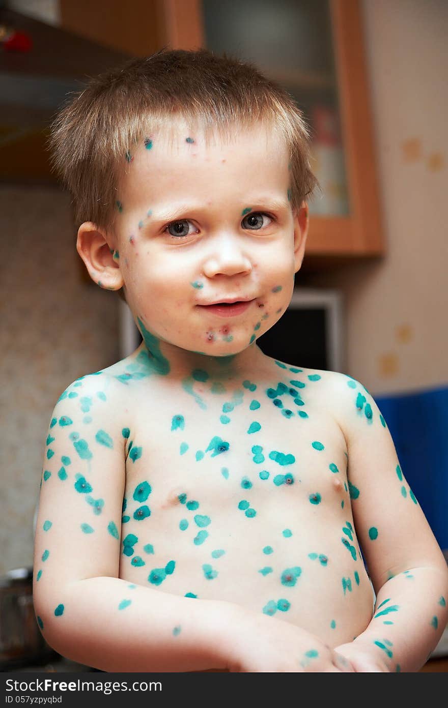 Little boy is sick with chickenpox closeup indoors