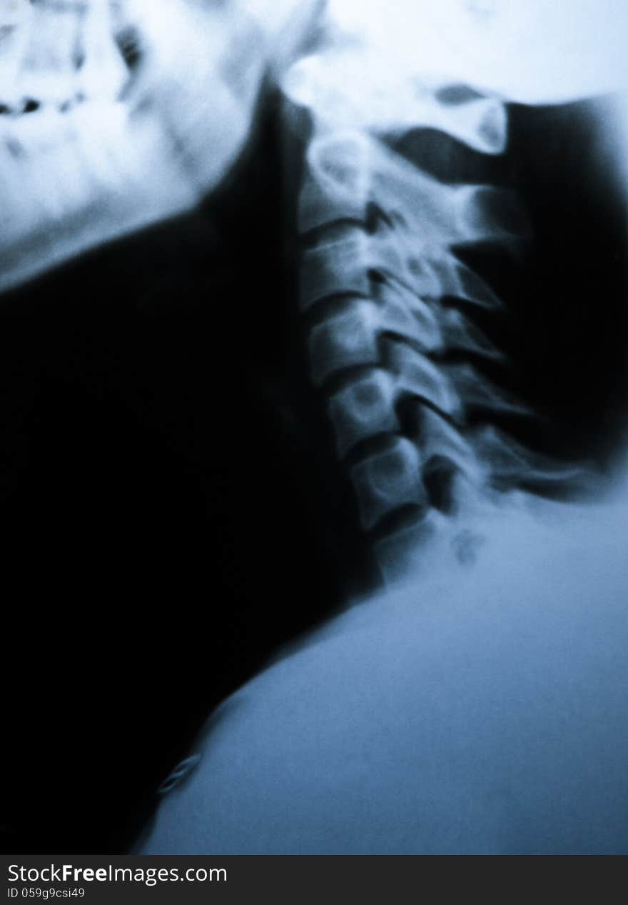 X-ray photograph of human neck bones. Side view. X-ray photograph of human neck bones. Side view.