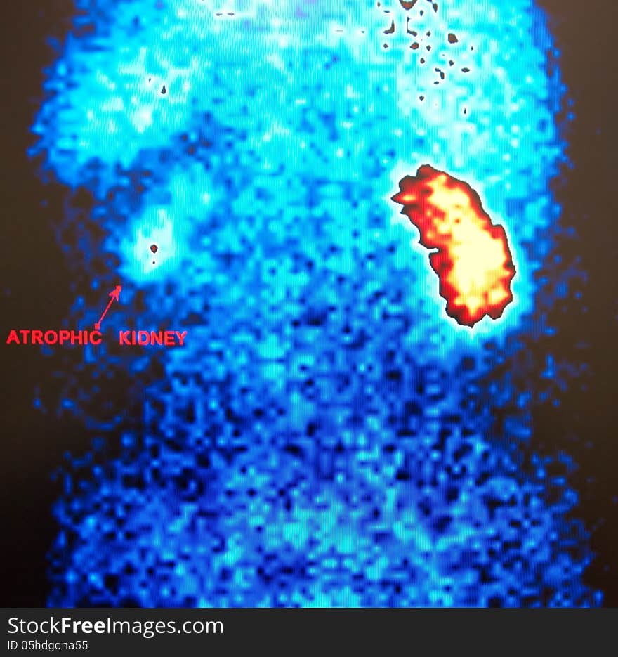 Renal flow nuclear scan reveals atrophic kidney, which has abnormal size and function , second kidney has normal size and function ,impressive diagnostic test in practice of urologist. Renal flow nuclear scan reveals atrophic kidney, which has abnormal size and function , second kidney has normal size and function ,impressive diagnostic test in practice of urologist