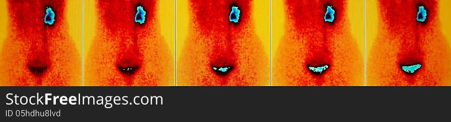 Renal flow nuclear medicine