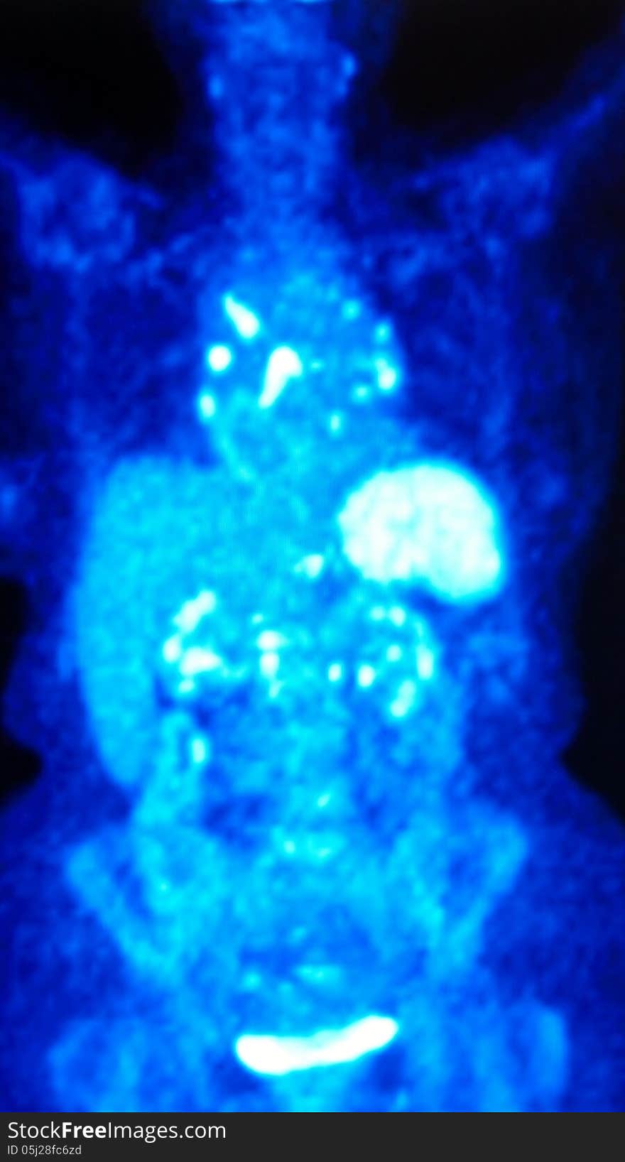 Pet/ct image FDG isotope ,which is very specific for oncological diagnostic. Pet/ct image FDG isotope ,which is very specific for oncological diagnostic