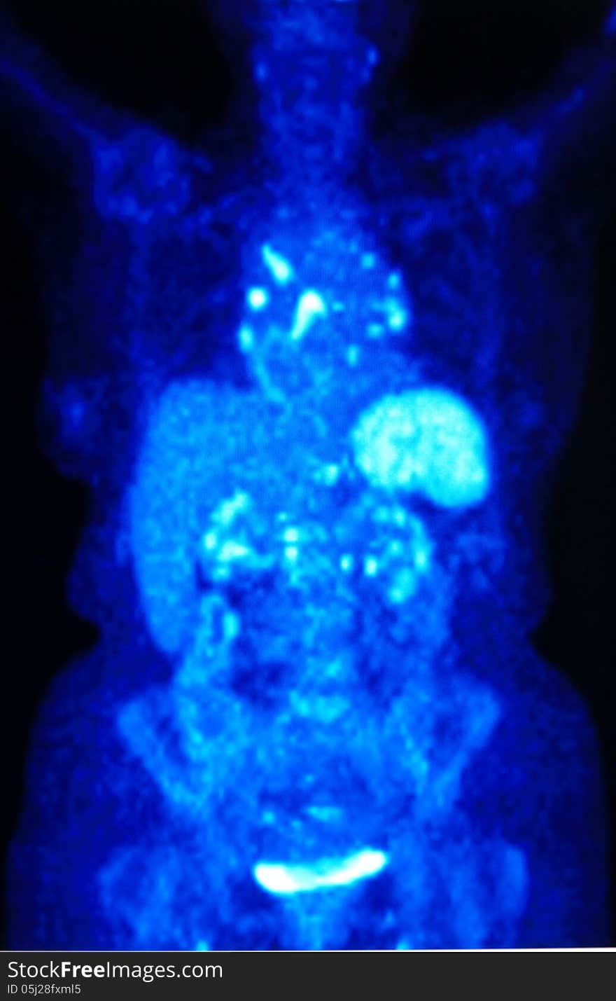 Pet/ct image ,whole body scan, FDG isotope ,which is very specific for oncological diagnostic. Pet/ct image ,whole body scan, FDG isotope ,which is very specific for oncological diagnostic