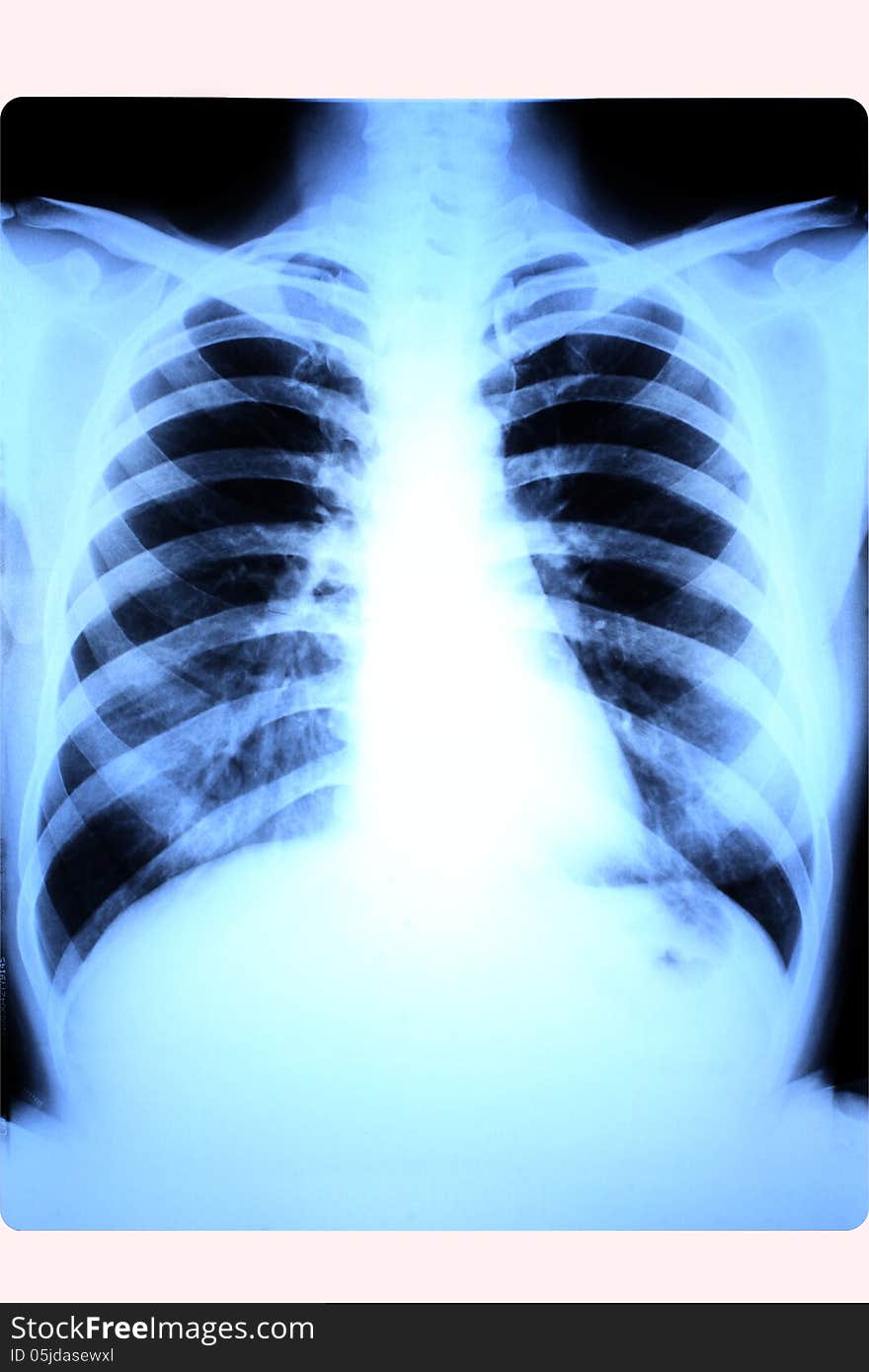 X-ray scan of lungs or female chest. X-ray scan of lungs or female chest