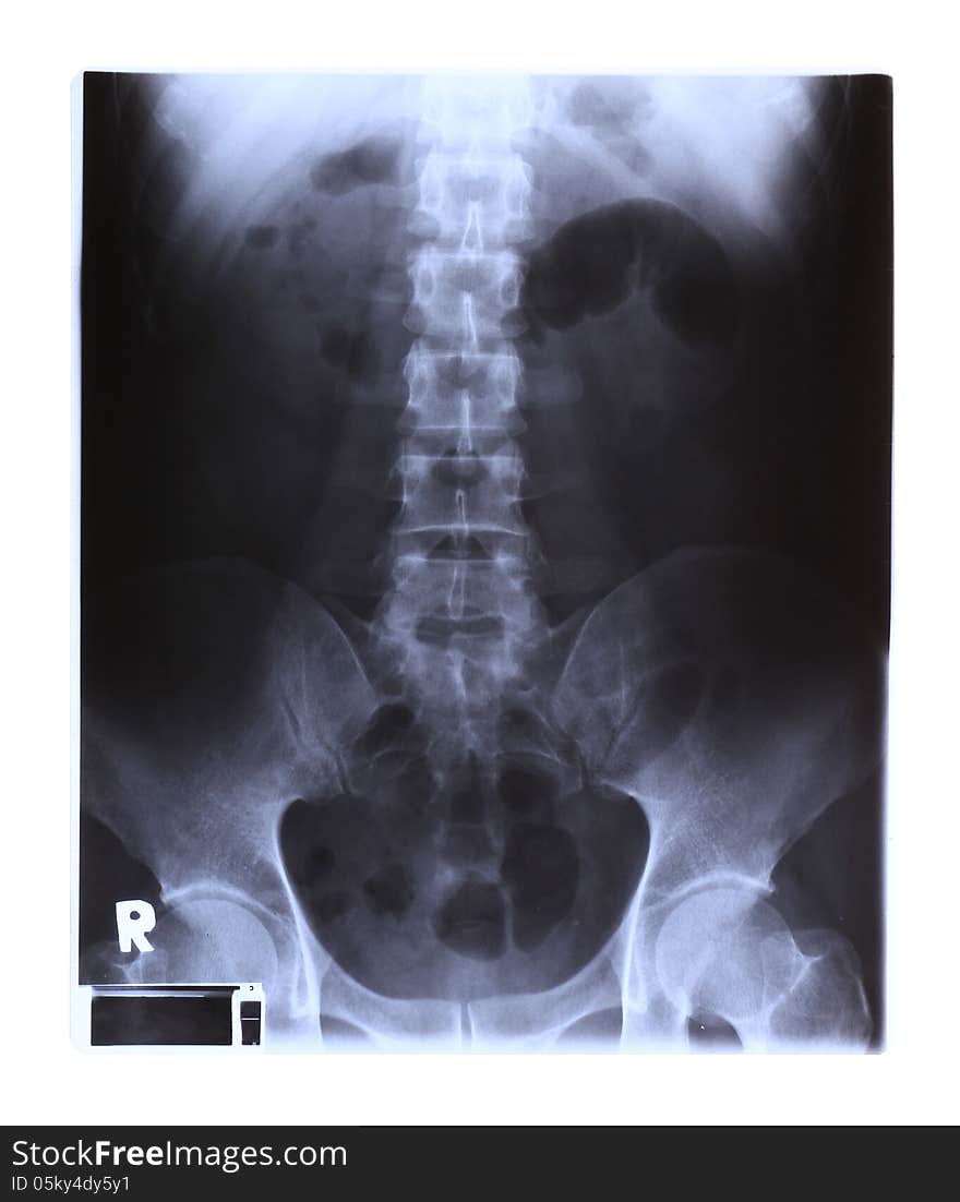 X-ray film of spinal column and pelvis isolated on white background