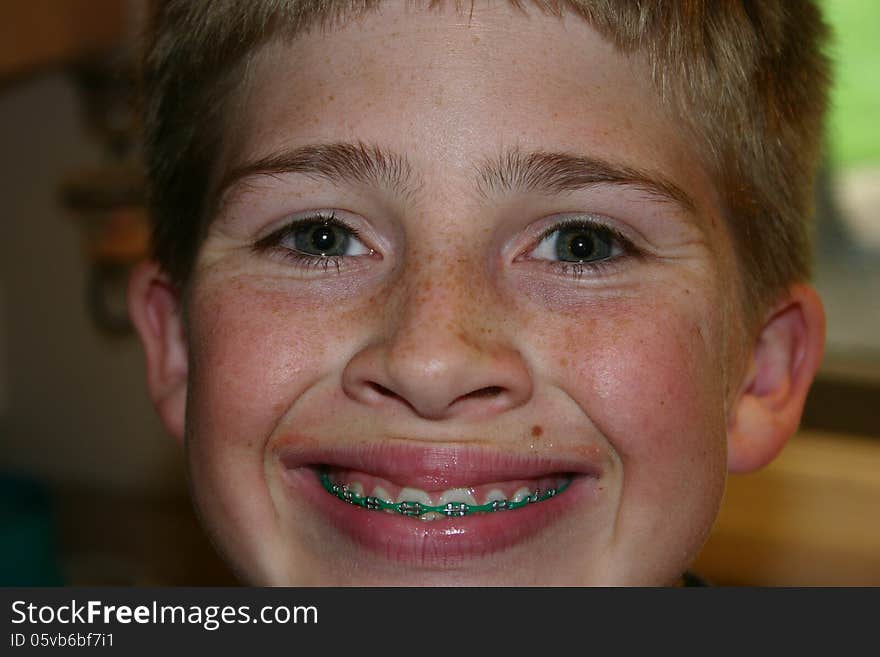 Boy smiling in braces