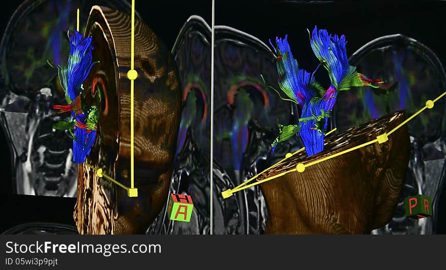 Diffusion tensor imaging is technique of Brain Magnetic Resonance image - allows the mapping of the diffusion process of molecules, mainly water in tissues, especially in brain. Color coded white matter tract of the brain can be seen in 3 different directions: up-down, left-right, forward-backward. Diffusion tensor imaging is technique of Brain Magnetic Resonance image - allows the mapping of the diffusion process of molecules, mainly water in tissues, especially in brain. Color coded white matter tract of the brain can be seen in 3 different directions: up-down, left-right, forward-backward