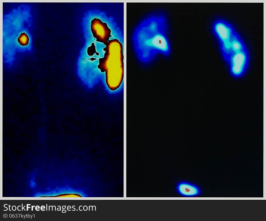 On the left site of image renal upj obstruction due to additional vessel ,on the right site after 4 weeks after laparoscopic pyeloplasty ,real result of treatment this pathology. On the left site of image renal upj obstruction due to additional vessel ,on the right site after 4 weeks after laparoscopic pyeloplasty ,real result of treatment this pathology...