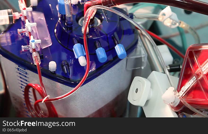 Cardiopulmonary bypass reservoir at cardiac surgery