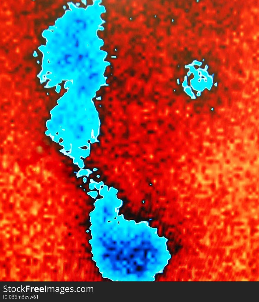 Renal flow pathology nuclear scan reveals ureterohydronephrosis (blue isotope ) of one of the kidney of patient ,which is most likely due to obstruction in the intramural part of ureter. Renal flow pathology nuclear scan reveals ureterohydronephrosis (blue isotope ) of one of the kidney of patient ,which is most likely due to obstruction in the intramural part of ureter