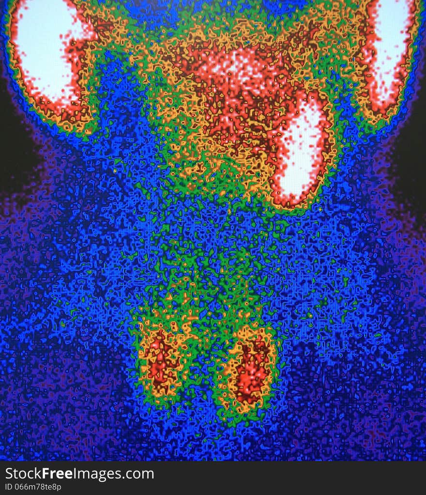 parathyroid  pathology ,  nuclear scan