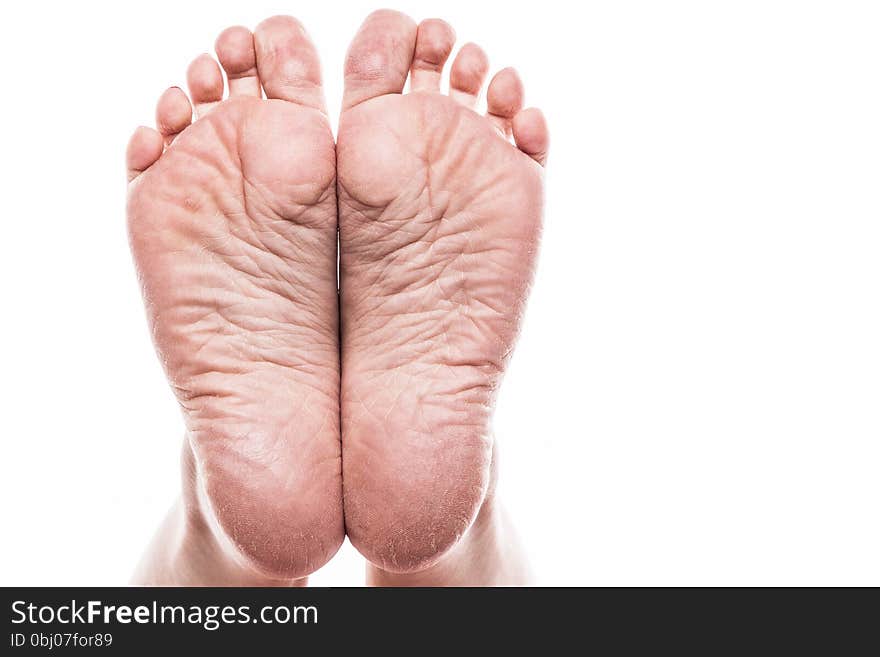 Female foot with pedicure and poor over-dry skin on the heels of