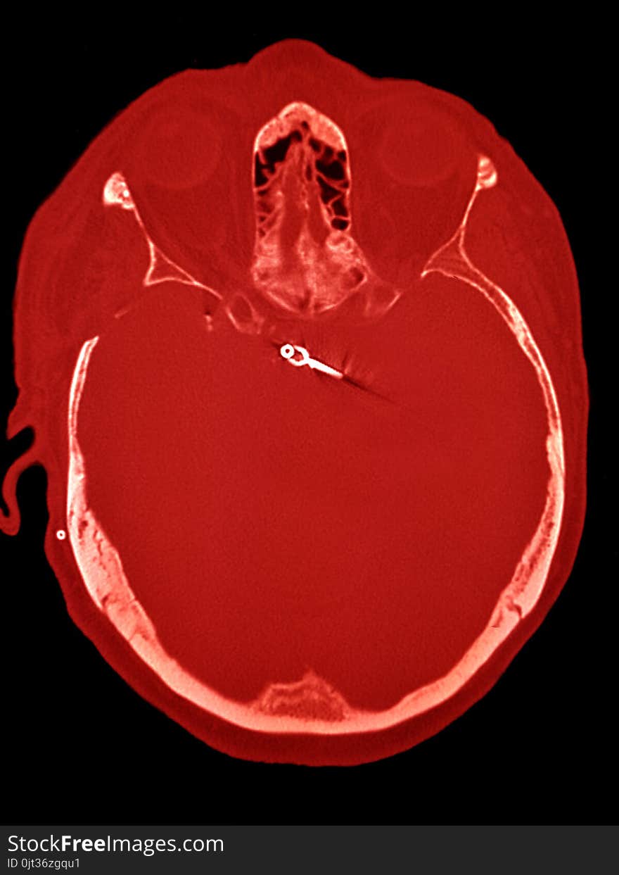 Clipsed cerebral aneurysm, illustration, CT, colored in red