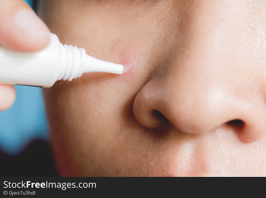 Close up of the woman heal acne by using a squeeze tube smear directly on the acne.