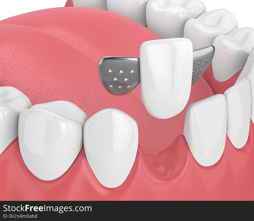 3d render of jaw with teeth and maryland bridge