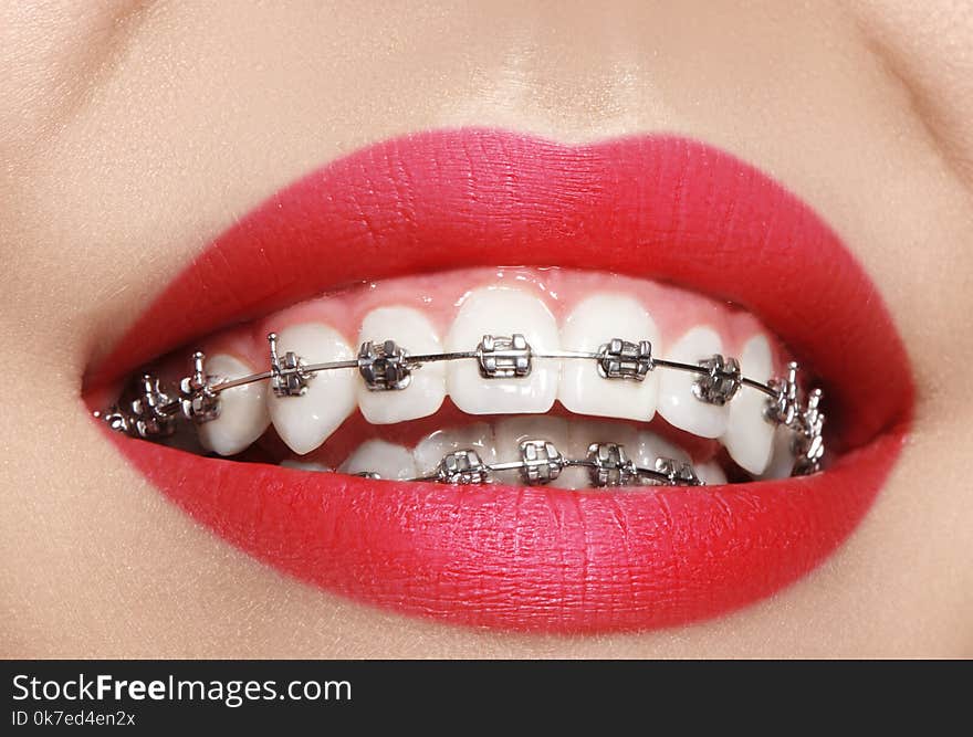 Beautiful macro shot of white teeth with braces. Dental care photo. Beauty woman smile with ortodontic accessories. Orthodontics treatment. Closeup of healthy female mouth