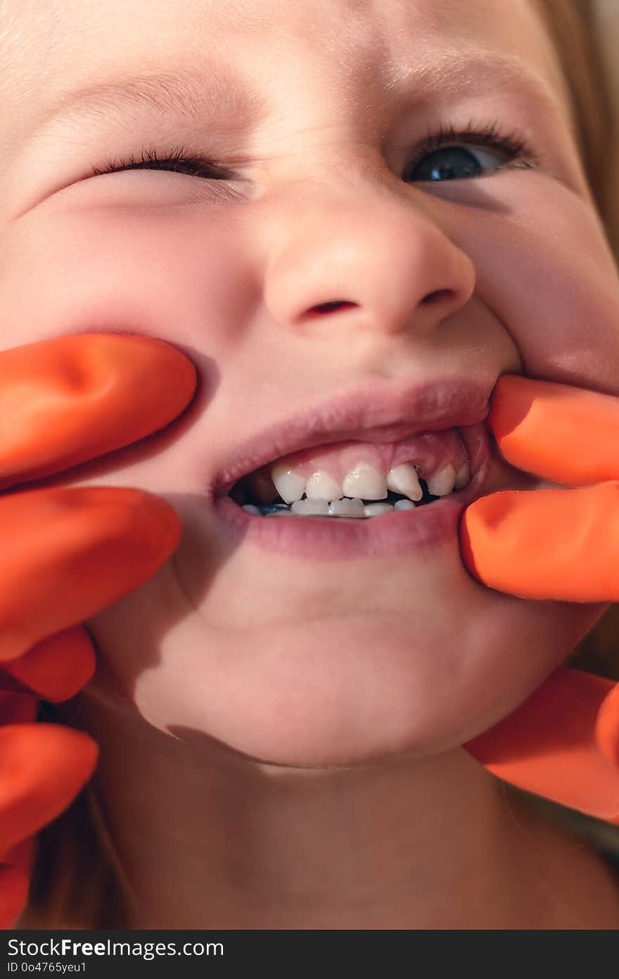 The doctor is trying to see the mouth of a little girl with an orthodontic appliance and crooked teeth. Wobbly tooth.