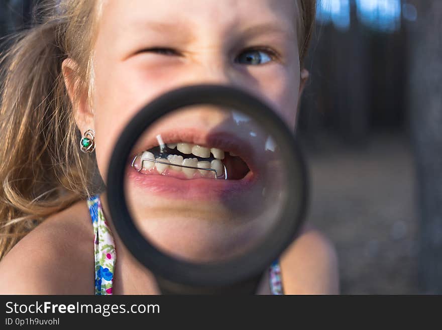 A little girl put a magnifying glass to her mouth to show an orthodontic appliance, crooked teeth and a wobbly tooth.