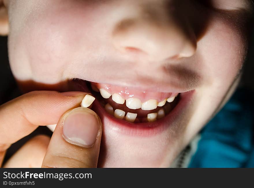 Child opening his mouth with a fallen tooth. Boy smilling in dentistry concept.