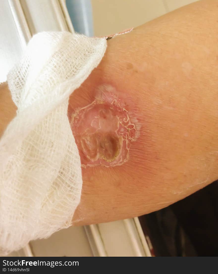 The wound diabetic arm disease and burn wound from hot water, Medical and healthcare concept