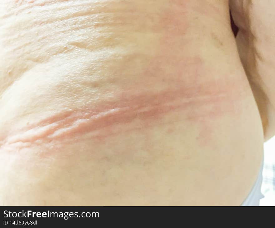 Ill allergy rash dermatitis eczema skin of patient.red rash