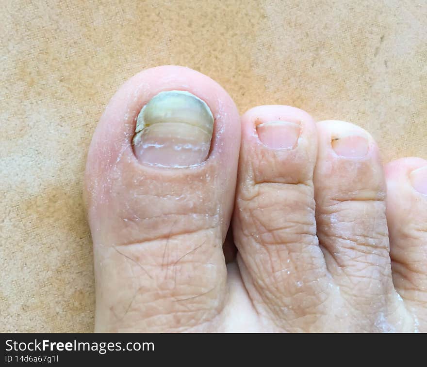 Toe is fungal infection.Medical, treatment, health and medicine concept.Dermatologist