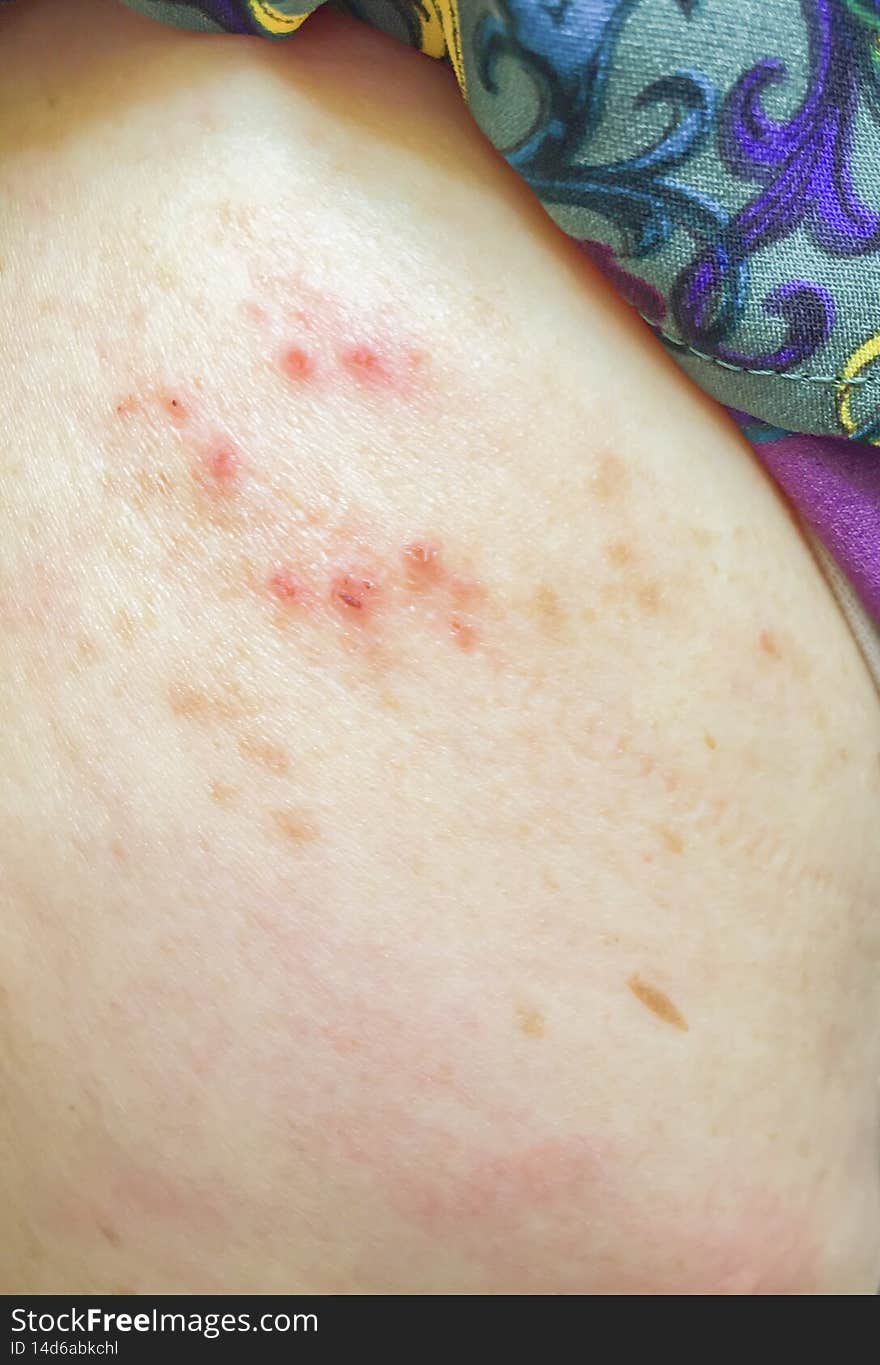 Ill allergy rash dermatitis eczema skin of patient.red rash.