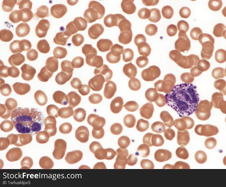 Eosinophil and basophil in peripheral blood smear. Wright x1000.